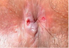 肛门瘙痒、红肿是怎么回事