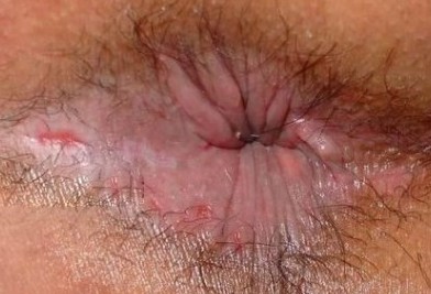 肛门湿疹.jpg