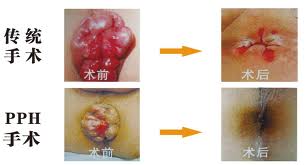 PPH微创术