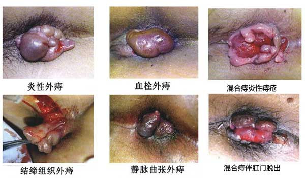 痔疮的类型