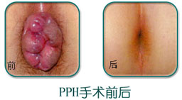 痔疮PPH手术费用，点击咨询